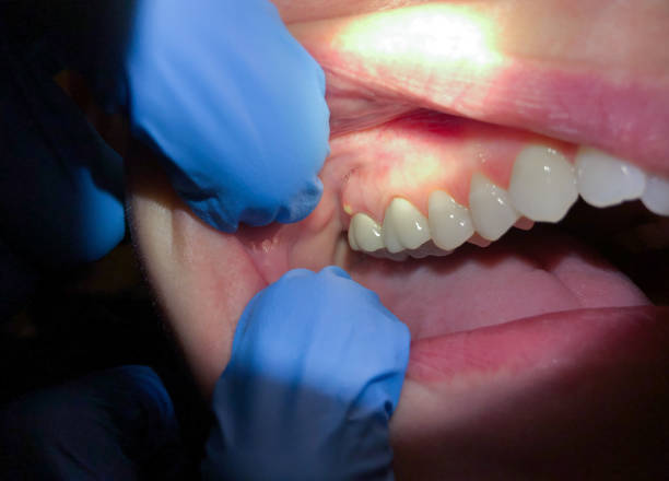 Best Emergency Dentist for Lost Fillings or Crowns in Wilder, VT
