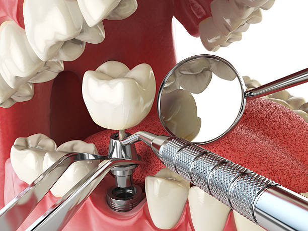 Best Emergency Dentist for Lost Fillings or Crowns in Wilder, VT