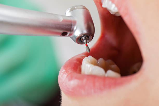 Best Emergency Root Canal Treatment in Wilder, VT